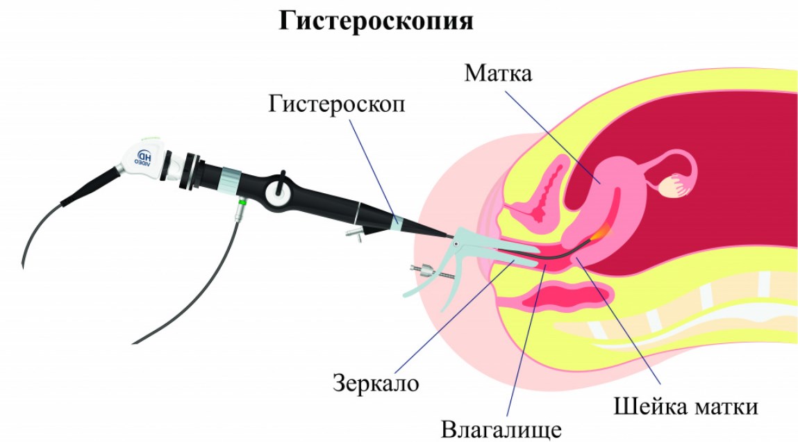 Секс После Удаления Полипа Секс После Удаления Полипа